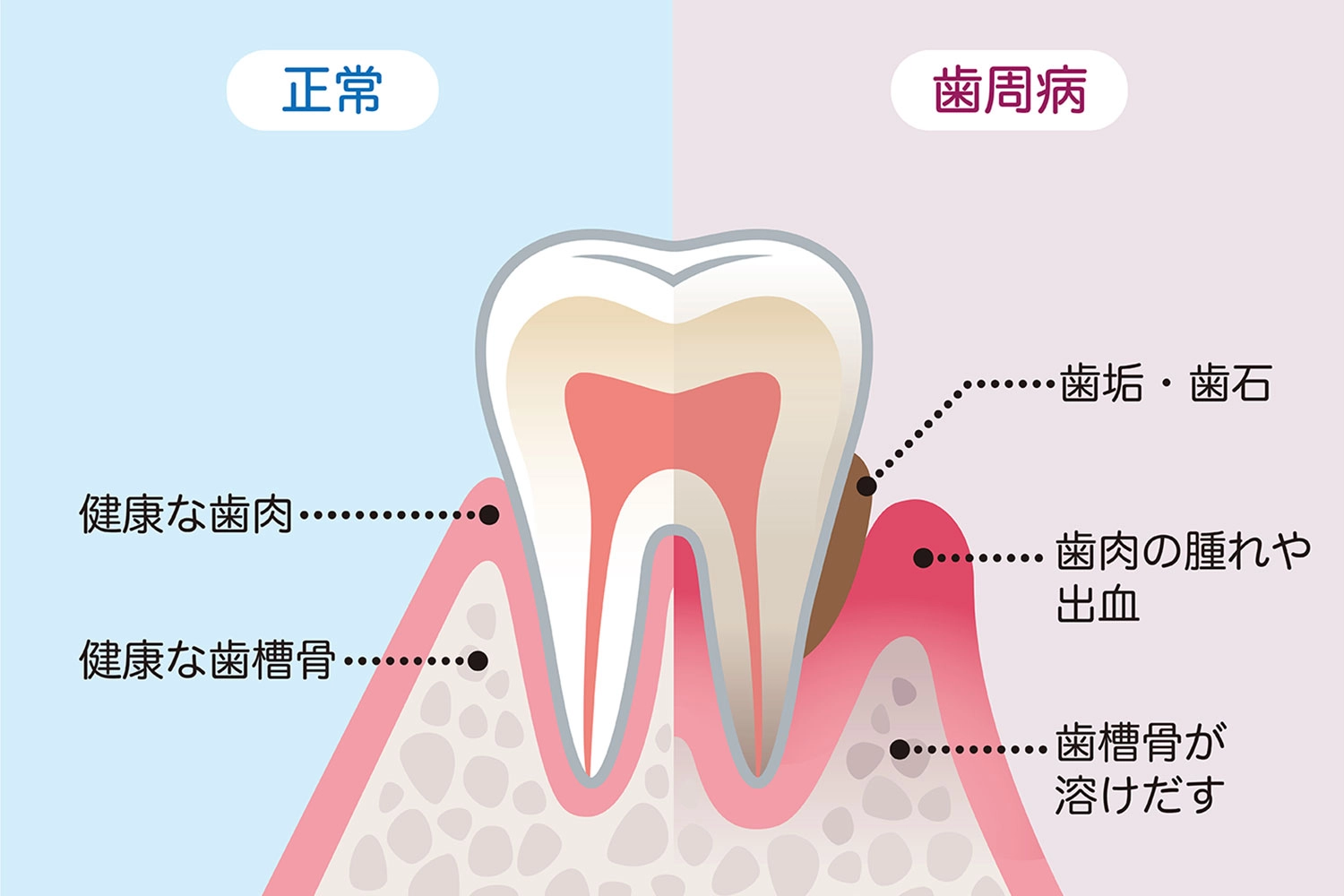 正常な歯ぐきと歯周病の歯ぐきの比較