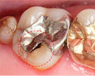 銀歯が取れてしまった方