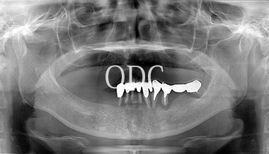 オールオンフォー症例2-1