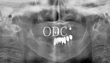 オールオンフォー症例3-1