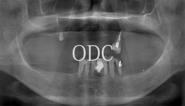 オールオンフォー症例5-1